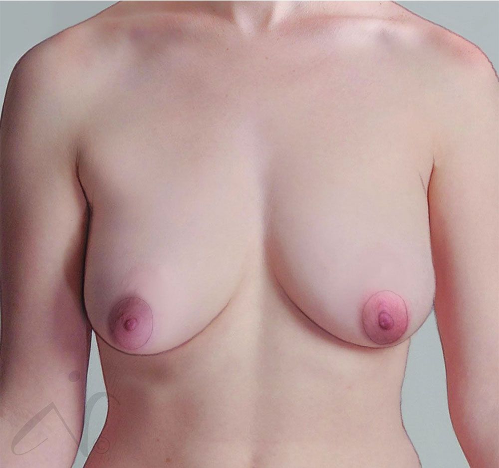 before simulation of breast lift in bend, or