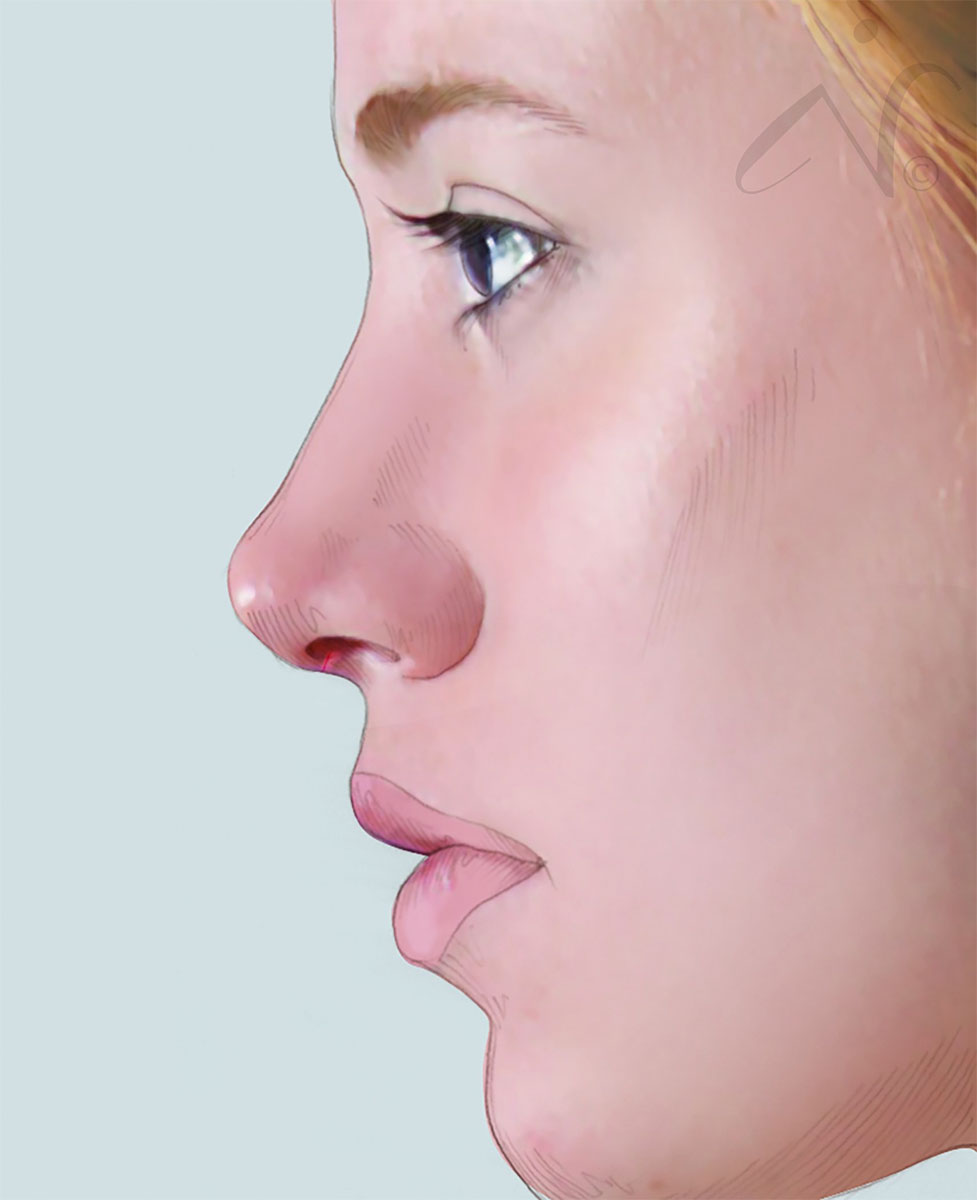 after simulation of rhinoplasty in bend, or