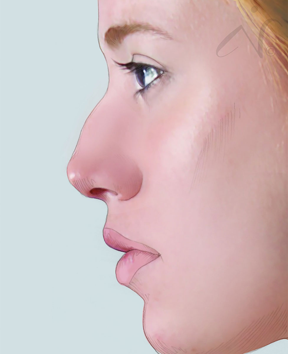 before simulation of rhinoplasty in bend, or